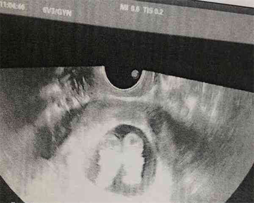 2026子宫内膜异位症对做三代试管婴儿有影响吗？附三代试管成功率！